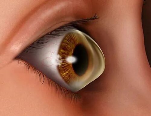 علاج القرنية المخروطية