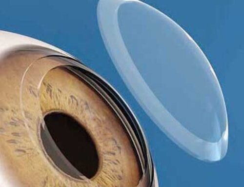 عملية زراعة القرنية