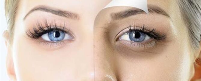 علاج الهالات السوداء تحت العينين